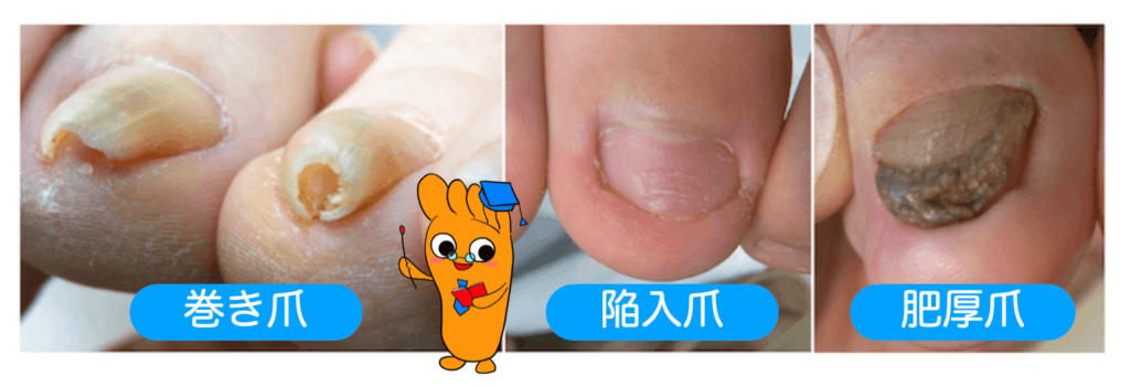 巻き爪　陥入爪　爪甲鉤彎症 (1)